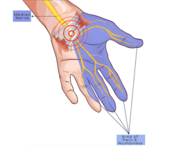 Carpal-Tunnel