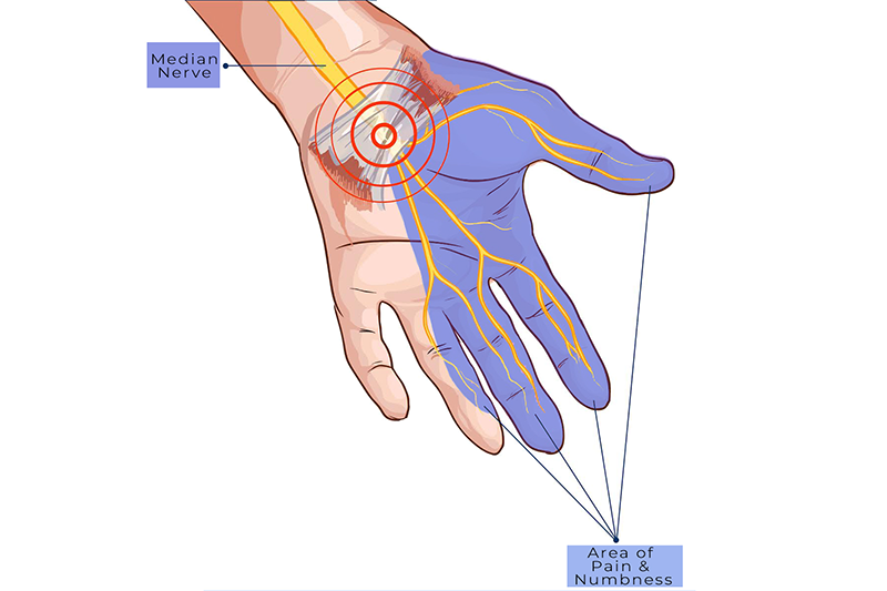 Carpal-Tunnel